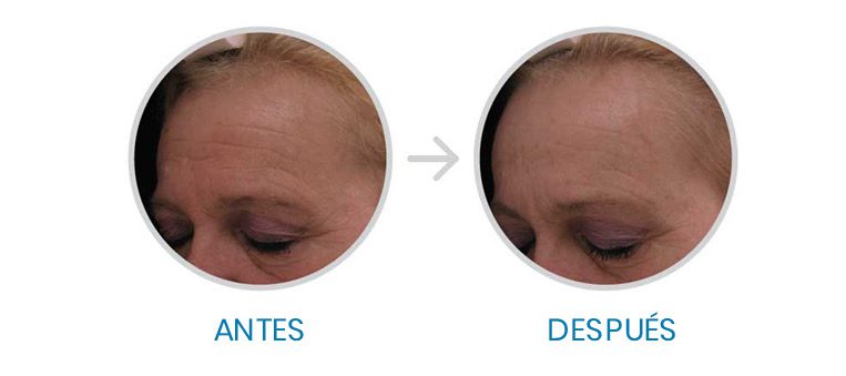 antes-despues-renu-28